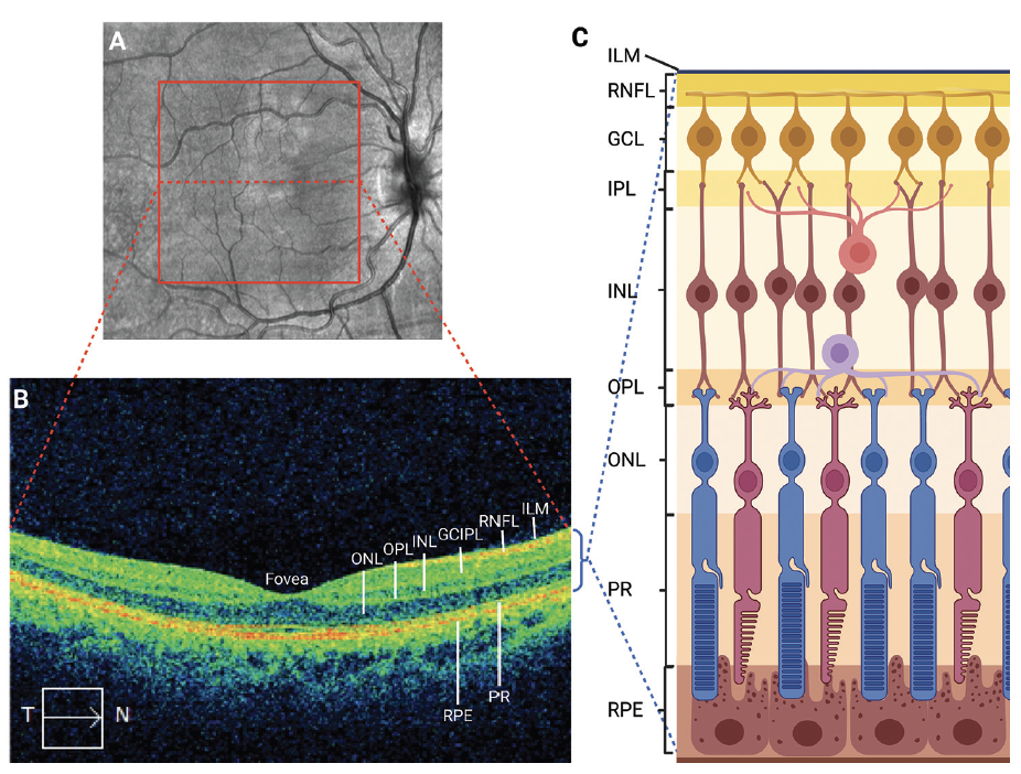 Image of Comprehensive Retinal Health Analysis of 1000 Individuals: A Detailed Report